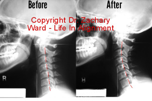 Pre and post xray upper cervical chiropractic care