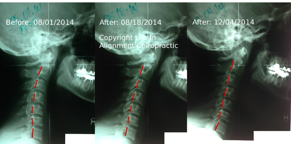 Reverse cervical curve before and after Life In Alignment Auburn Hills Michigan