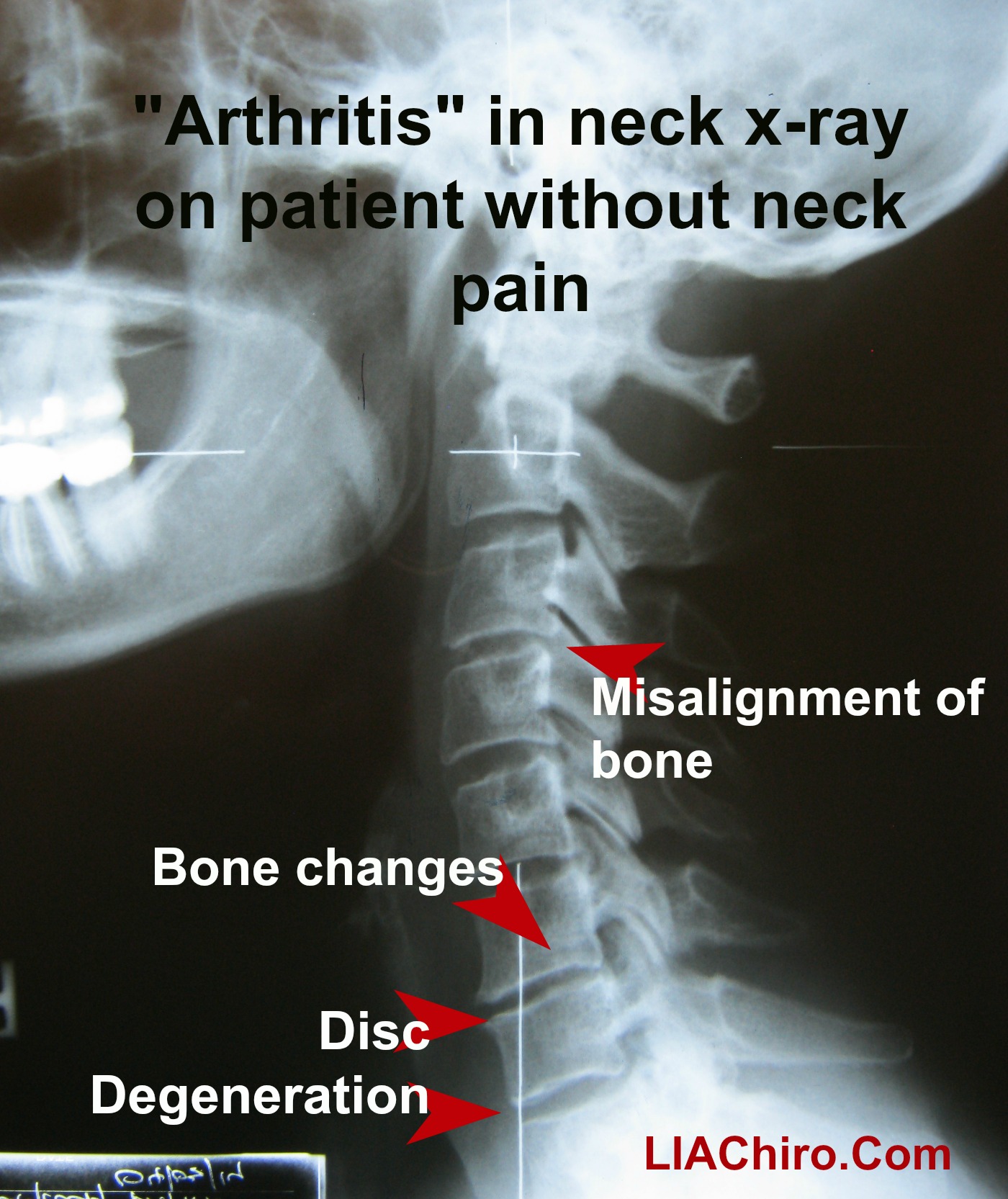 Arthritis and chirorpactic